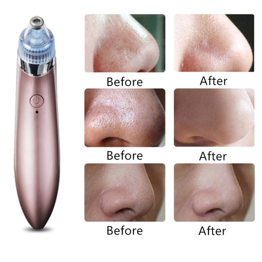 Removedor de Espinillas Electrico ⭐⭐⭐⭐⭐